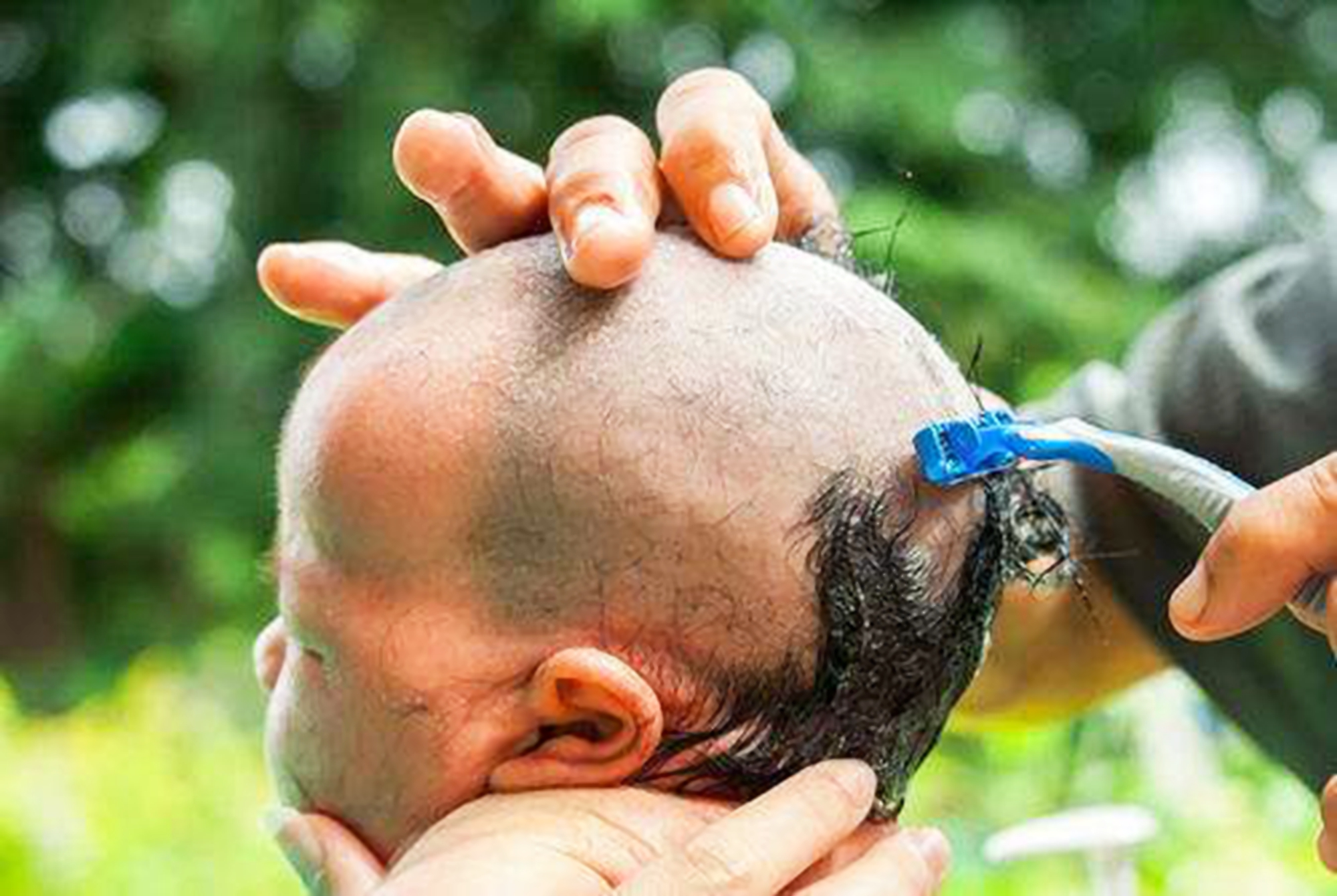 宝宝头上斑秃是什么原因造成的,是不是每个宝宝都秃顶