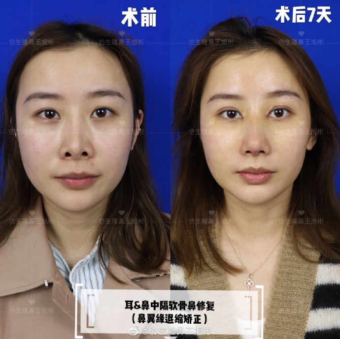 假体隆鼻耳软骨垫鼻尖图片,l型假体耳软骨隆鼻图片