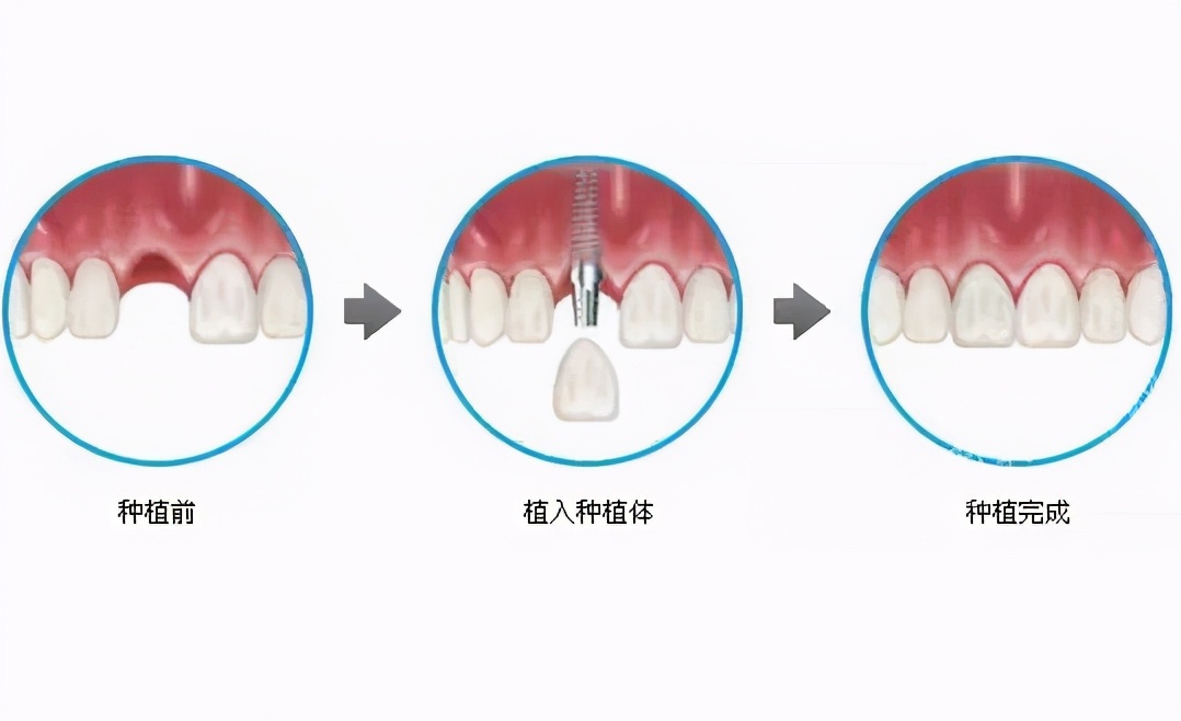 种植牙后果怎样,种植牙的风险和注意事项