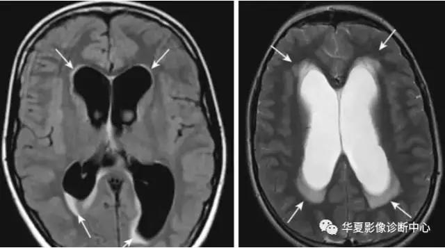 各型脑水肿影像及病理、生理解析