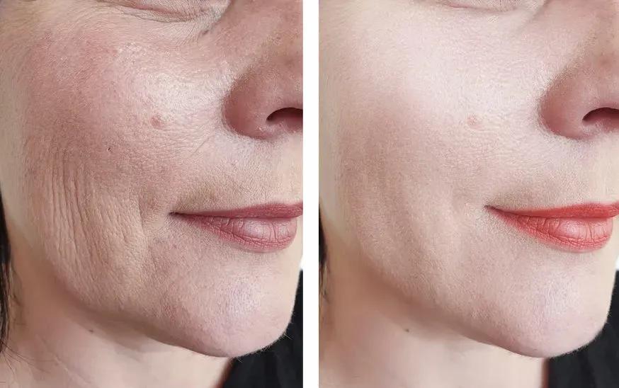 7d聚拉提和热玛吉超声刀哪个贵,热玛吉和超声刀7d哪个提拉效果好