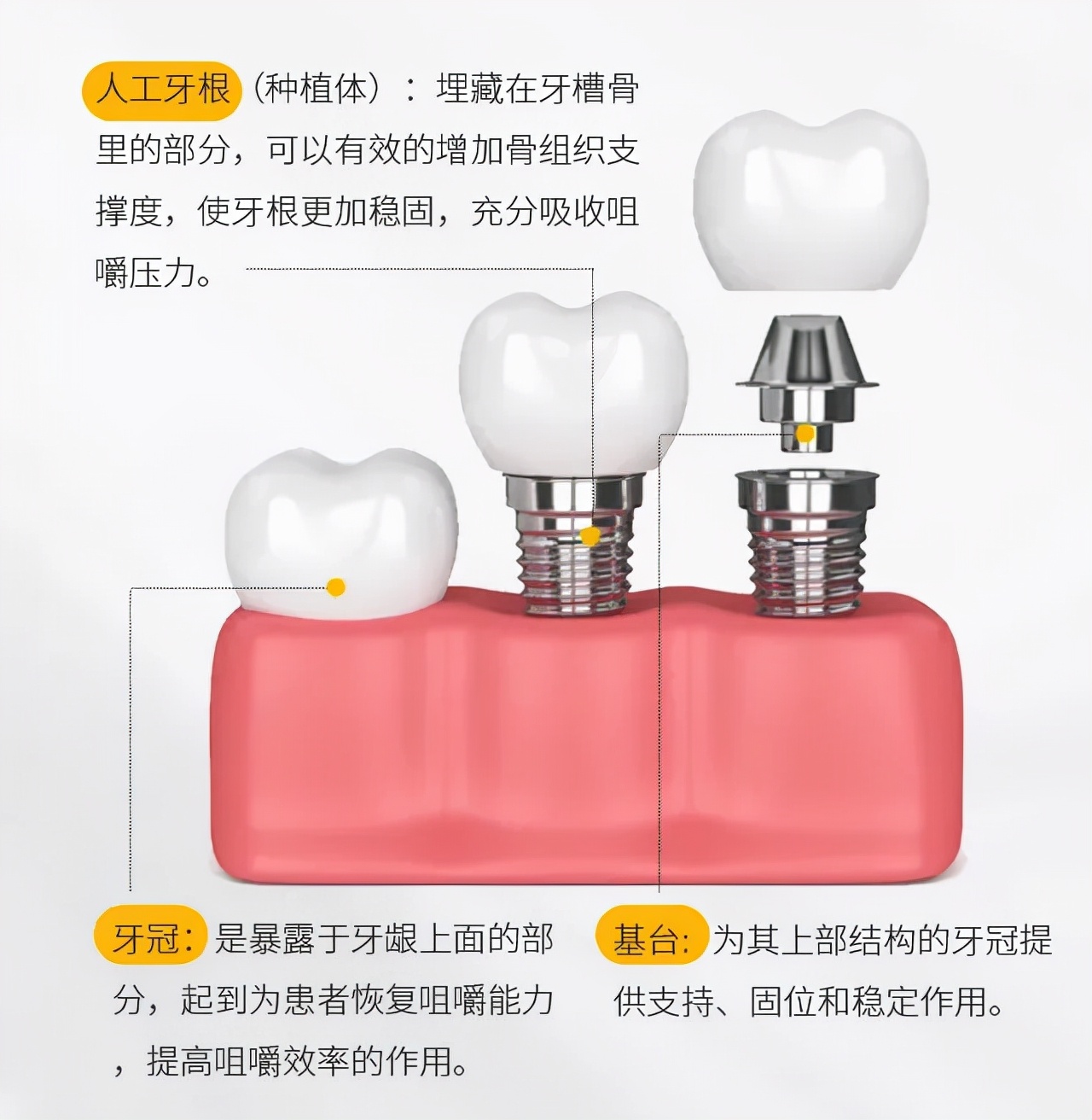 全口种植牙要种几颗呢,种植牙坏了可以再种吗