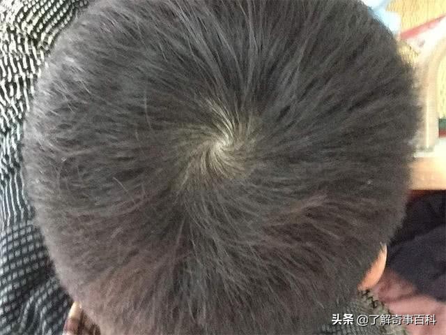 孩子头顶太多旋,孩子头顶有2个旋到底代表啥
