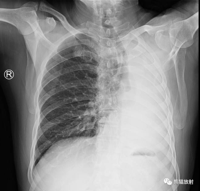 x线诊断边界模糊,x线诊断有误区吗