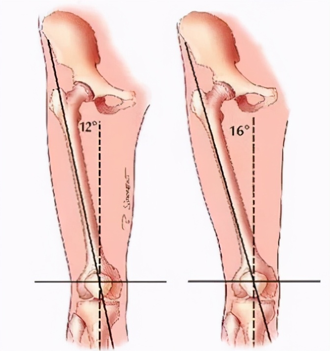 跑步对膝盖的正确训练,错误跑步姿势小腿疼怎么办