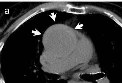 如何监测动脉夹层早期,动脉增强ct能查出主动脉夹层么