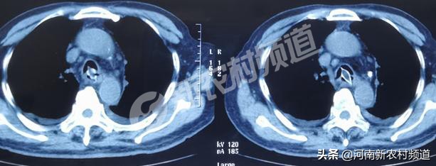 72岁老人误吞枣核后续,81岁老人误吞杏核