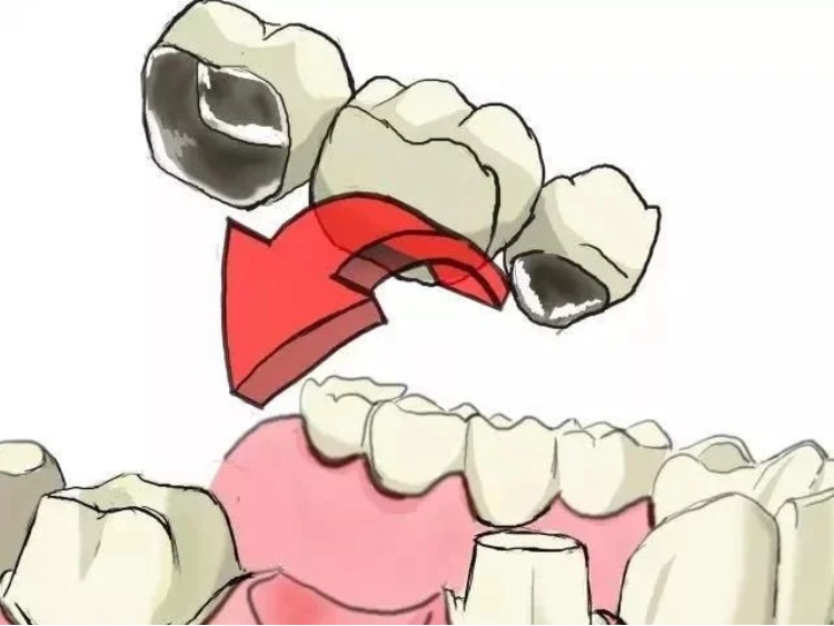 良心牙医不建议拔智齿残根,牙齿残根怎么处理视频