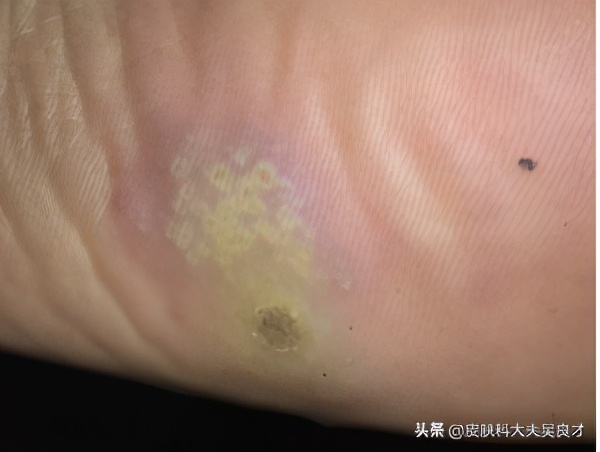 初期鸡眼和跖疣的区别,鸡眼和跖疣最简单的区别