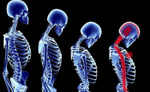 颈椎生理曲度变直如何能快速恢复,颈椎生理曲度变直能恢复吗