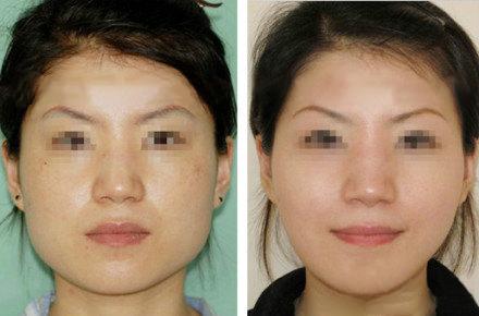 咬肌切除瘦脸术的注意事项,咬肌怎么切除