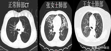 新冠无症状密接要紧吗,新冠密接无任何症状