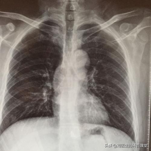 新型冠状肺炎有效治疗措施,新型肺炎防控三个必须