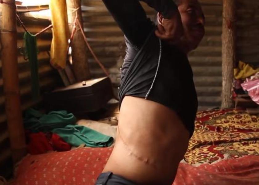 尼泊尔“卖肾村”：穷人700美元卖一个肾，人人身上一道疤