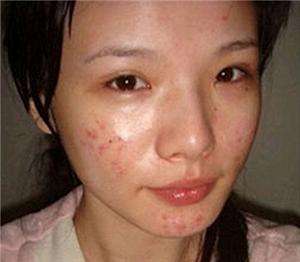 满脸粉刺皮肤油腻不堪,5个方法轻松解决,素颜也像化了妆一样