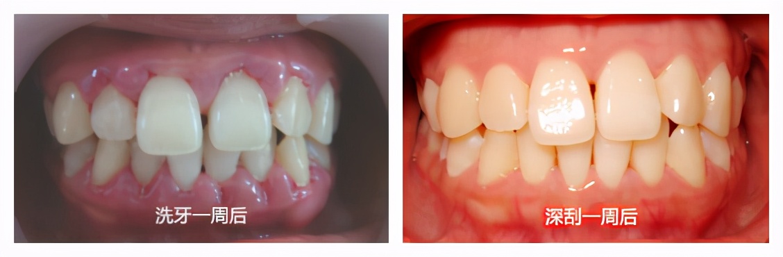蛀牙与牙周炎哪个更严重,慢性牙周炎口腔健康的头号杀手