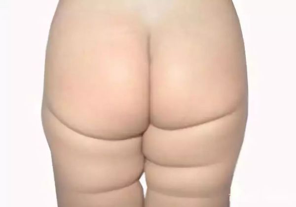 新生儿臀纹不对称双腿一样长,宝宝双腿纹路不对称有没有影响