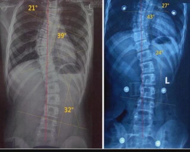 怎么知道脊柱侧弯的危害和症状,造成脊柱侧弯的原因主要是什么