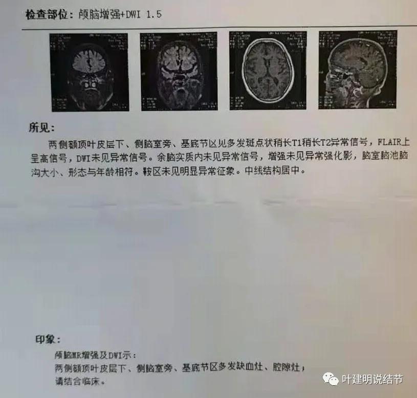 高龄肺癌靶向治疗效果,高龄老人肺癌早期适合放疗吗
