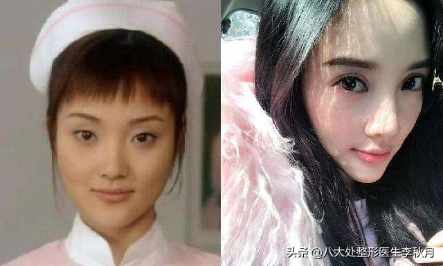 双眼皮刚做完很好看越恢复越难看,双眼皮做完感觉自己睁眼睛不自然