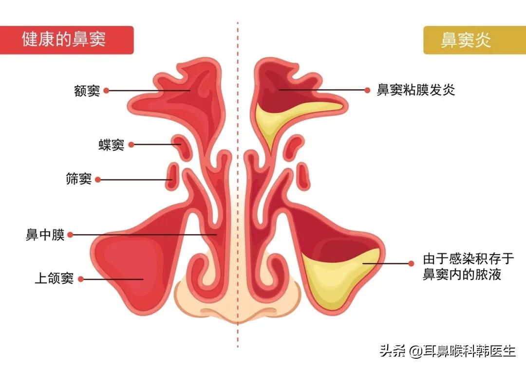 小儿鼻窦炎的原因有哪些,小儿鼻窦炎是怎么回事