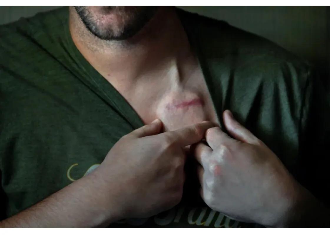 毒瘾治疗失败了。脑部手术能救他吗？