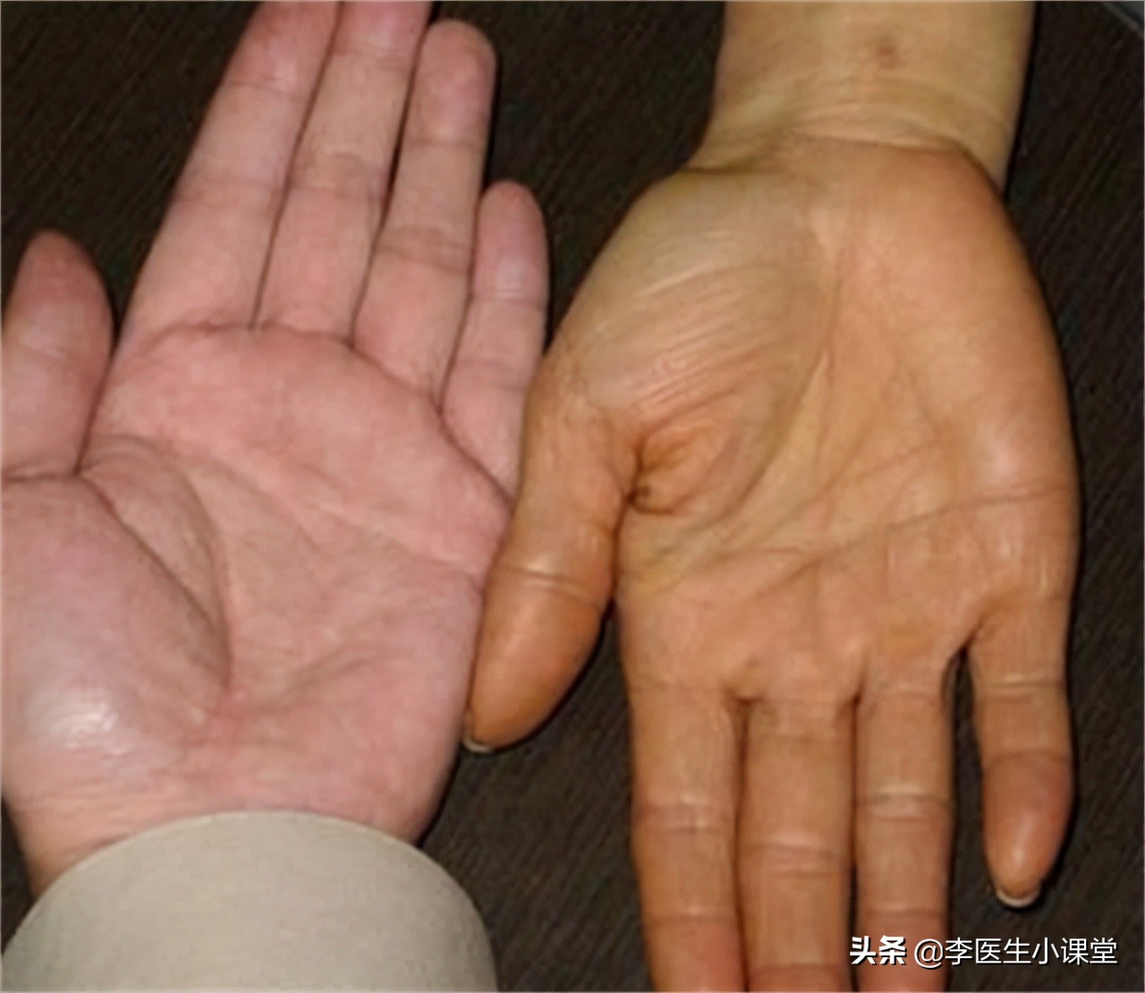 胆红素稍高一点要紧吗,胆红素稍高吃什么药