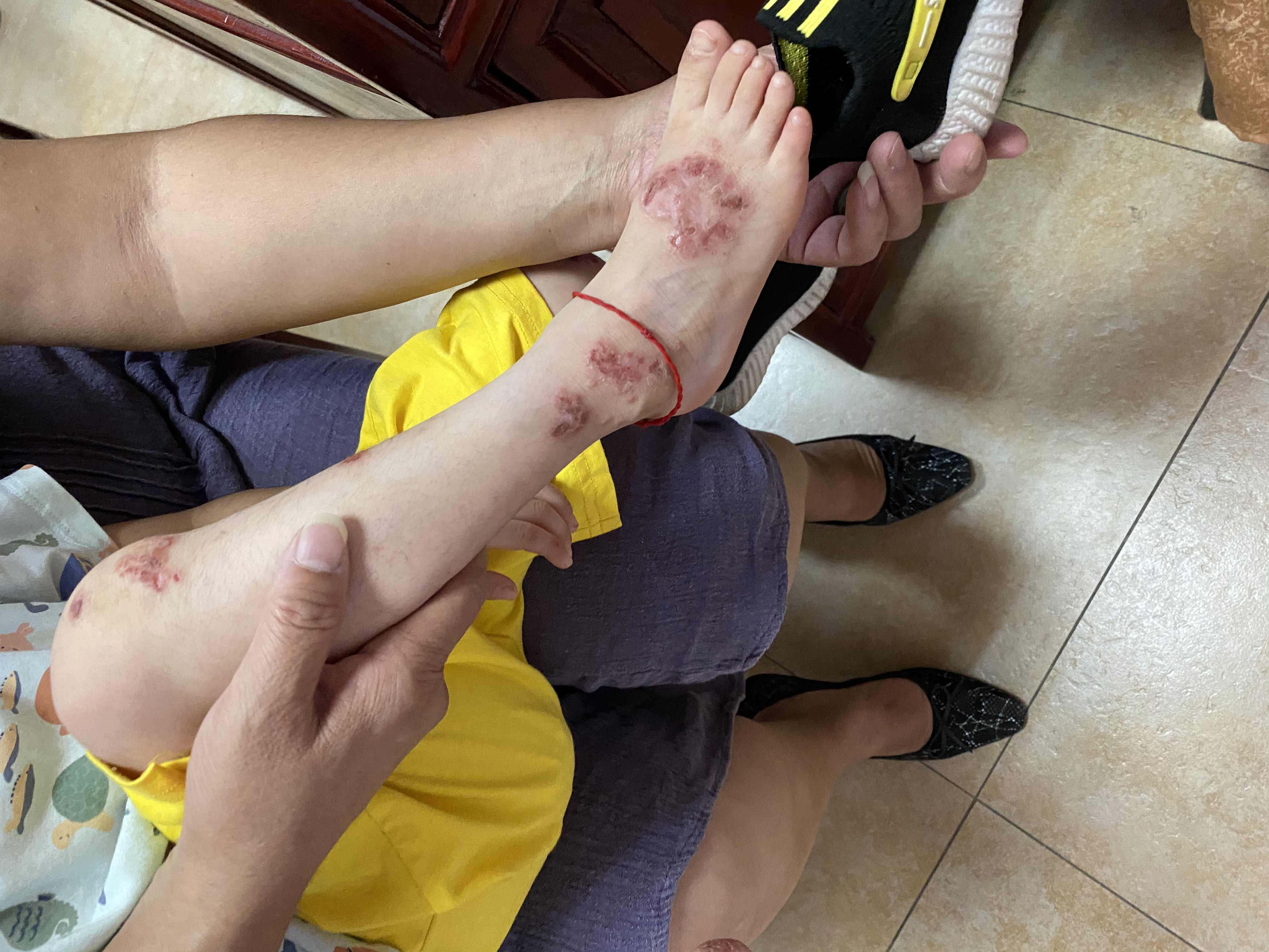 孩子湿疹怎么办家长需要注意哪些,小孩湿疹怎么办最有效方法