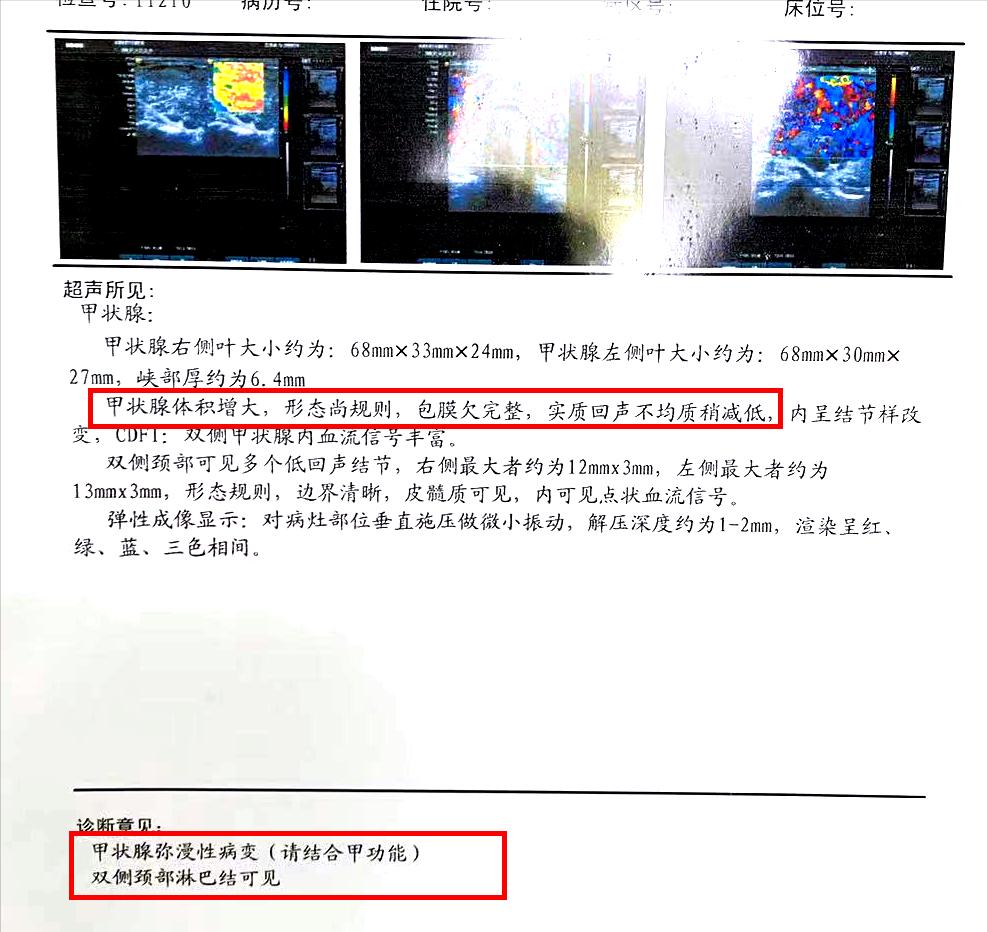 桥本氏甲亢吃药成甲减能恢复么,桥本甲亢是自身免疫系统疾病吗