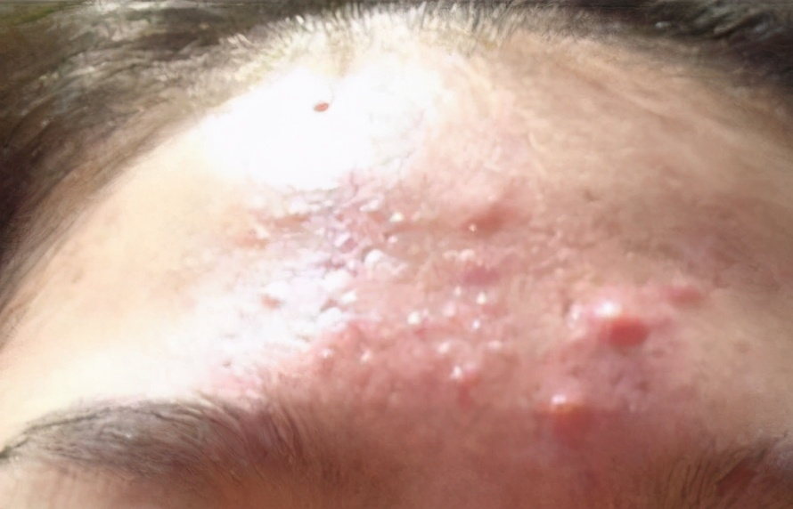 痘痘可以挤吗正确处理方法告诉你,哪种痘痘能挤哪种痘痘不能挤