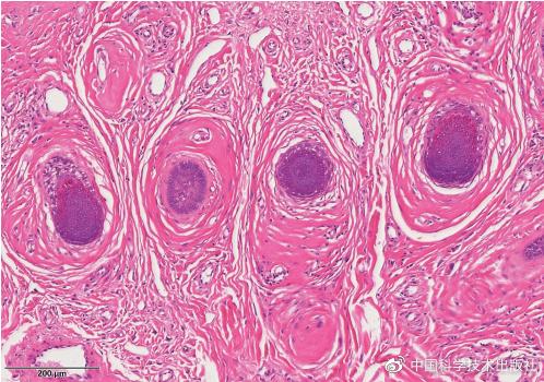 皮肤及附属器源性肿瘤,肿瘤病理诊断书
