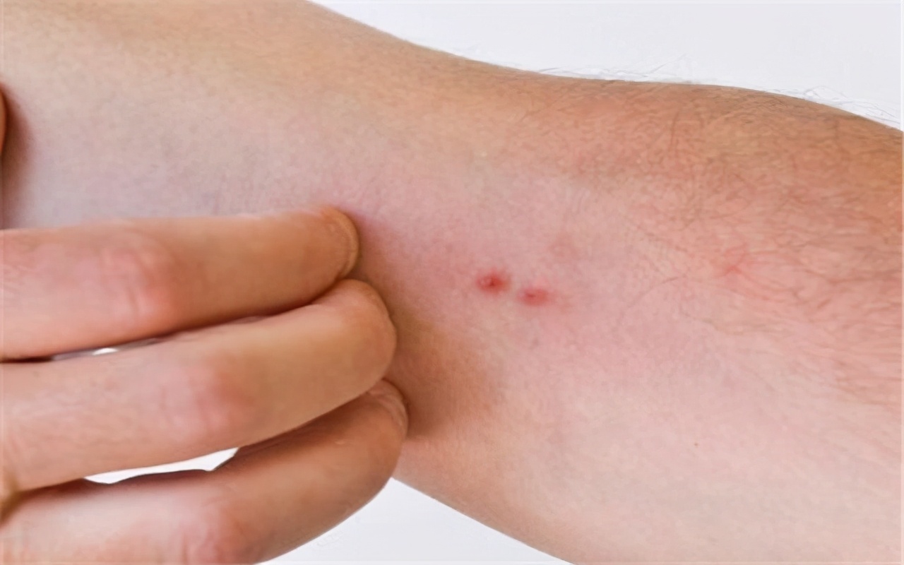 艾滋病的皮肤病会反复出现吗,艾滋病的早期表现别以为是皮肤病