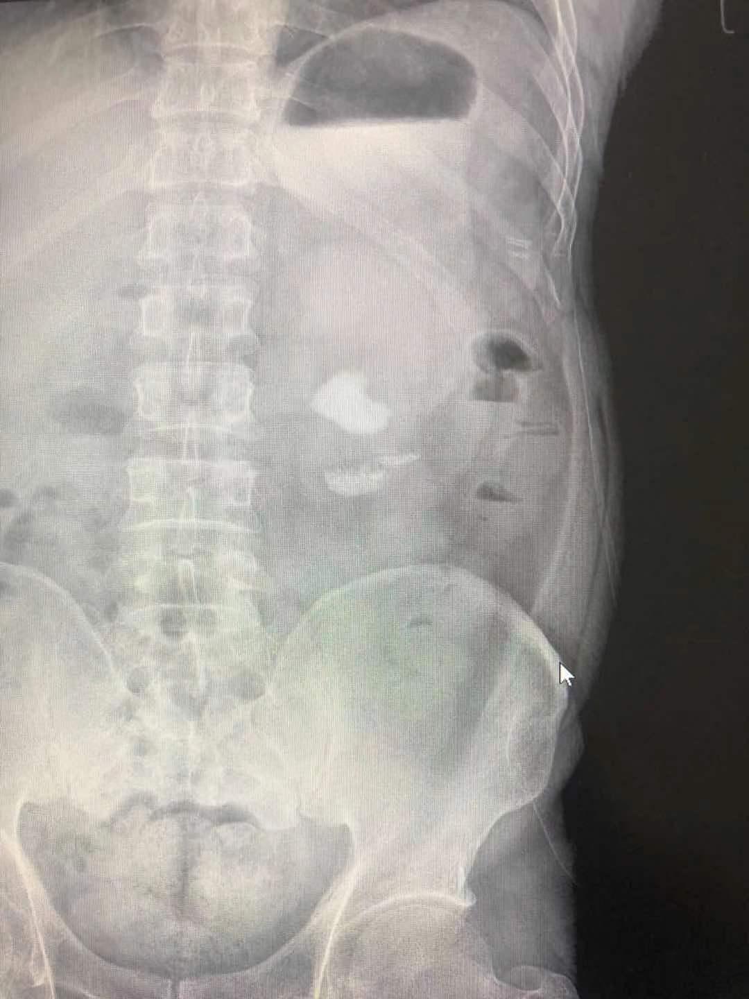 宝璋医院,利辛县宝璋医院泌尿外科怎么样