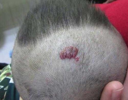 郴州市第一人民医院祛胎记,郴州第一人民医院治疗肝脏血管瘤