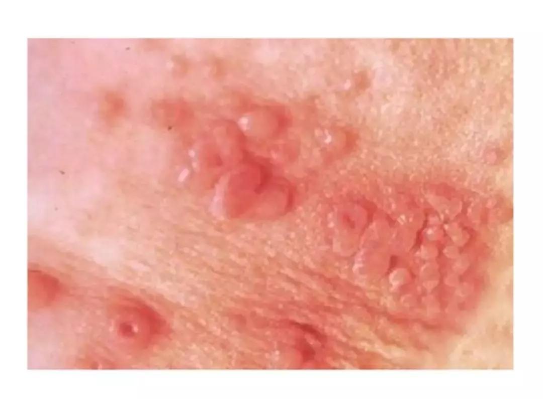 下身长疱疹怎么办,手上长疱疹怎么办