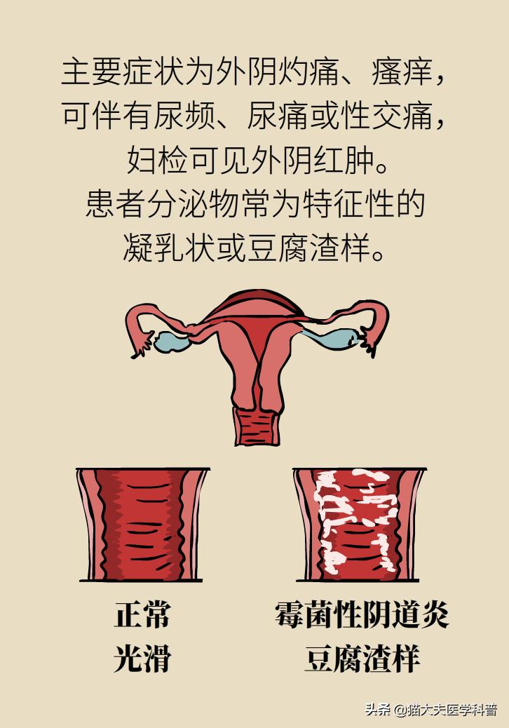 霉菌性阴道炎真的是里面“发霉”了吗？药师教你“抗霉”*法大**