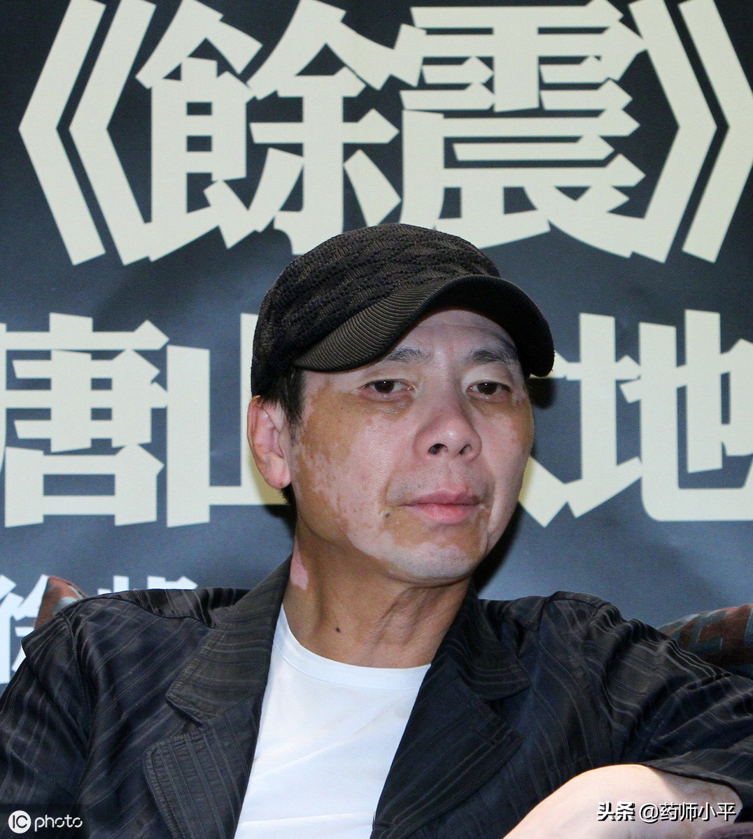 冯小刚对于白癜风的事情怎么说,冯小刚谈自己得白癜风