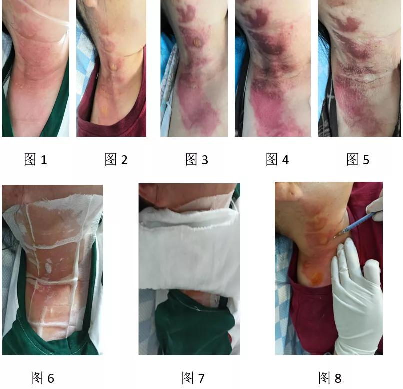 敌敌畏烧伤皮肤症状,敌敌畏中毒100毫升痊愈几率