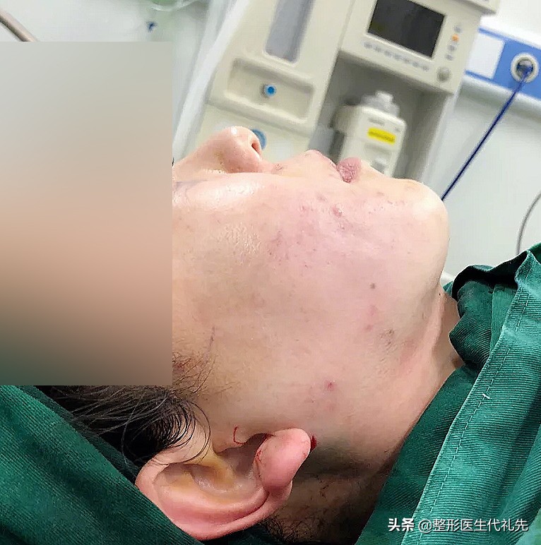 面部吸脂后会长痘痘吗,面部吸脂后皮下会长瘢痕吗