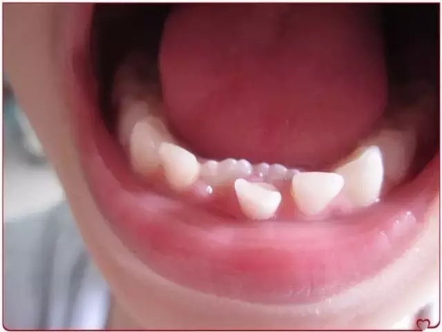 面对金口难开的家长该怎么沟通,青少年长双排牙怎么处理