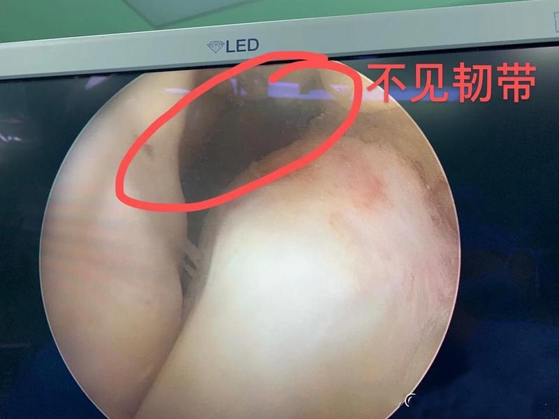 膝关节卡住能自愈吗,膝关节卡住了疼痛怎么办