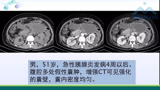 急性胰腺炎的护理措施,急性胰腺炎影像与临床