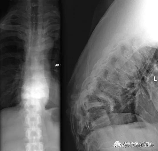 神经性脊椎炎,神经性风湿病