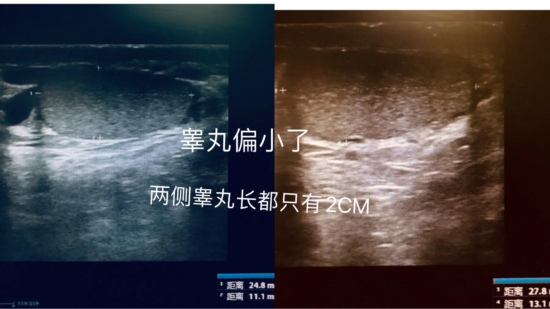 睾丸发生什么样的变化会影响生育,两侧睾丸都碎裂影响生育吗