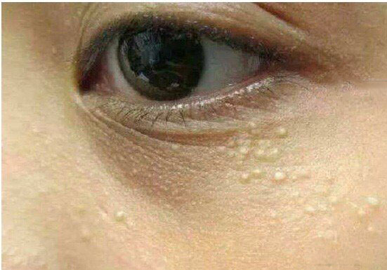 达人教你巧妙祛除眼部脂肪粒,眼部脂肪粒怎么去除小偏方图解