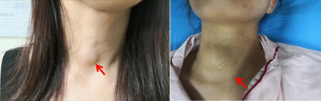 哈尔滨微创消融甲状腺结节哪家好,甲状腺结节微创消融术的过程