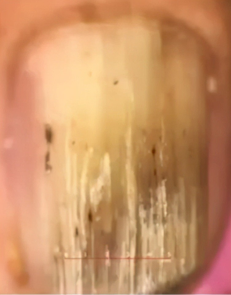 治灰指甲要验血吗,医院检查灰指甲挂号什么科