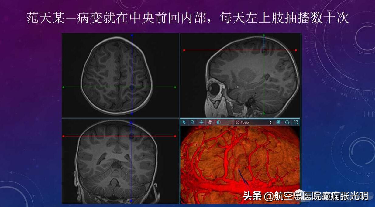 张光明左颞叶癫痫手术成功率,张光明谈治疗癫痫的方法有哪些