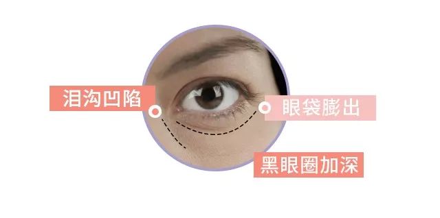 9个日常生活去黑眼圈小妙招,比较严重的黑眼圈怎么处理