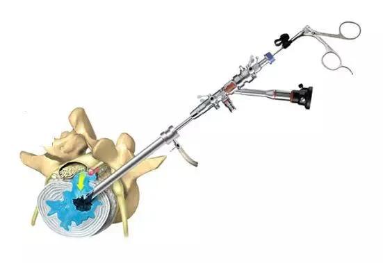 渭南治腰间盘突出哪家最好,脊柱神经外科手术